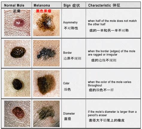 手掌突然長痣|痣也可能会癌变！长在 3 个地方要注意